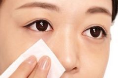 光子嫩膚能祛黑頭么？光子嫩膚可以去黑頭嗎？[多圖]