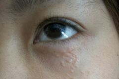用眼霜會(huì)長(zhǎng)脂肪粒嗎？眼霜用了長(zhǎng)脂肪粒怎么辦？[多圖]