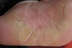 腳底裂開是什么原因？腳底裂開了口子怎么辦？[多圖]