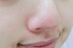 擠黑頭會(huì)使鼻子變大嗎？擠黑頭鼻子變大怎么辦？[多圖]