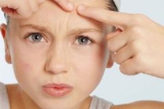 我14歲有很多黑頭怎么辦？黑頭能擠嗎？[多圖]