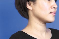 頸紋是怎么形成的？女人頸紋是怎么形成的？[多圖]