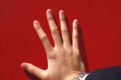 指甲上有白點(diǎn)是什么情況？指甲怎么看出健康狀況？[圖]