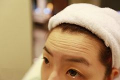 17歲額頭上有皺紋怎么辦？17歲額頭紋怎么去除？[多圖]