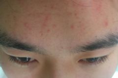 13歲臉上長痘痘怎么辦？13歲臉上長斑怎么辦？[多圖]