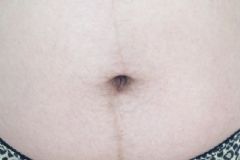 妊娠線會(huì)不會(huì)自己消失？生完寶寶妊娠線會(huì)消失嗎？[圖]