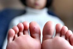 雞眼是怎么形成的注意哪些飲食？雞眼飲食注意哪些？[圖]