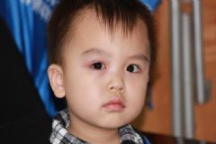 紅眼病的癥狀有哪些？紅眼病有哪些特征？[圖]