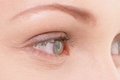 干眼癥需要做手術(shù)嗎？干眼癥能做手術(shù)嗎？[圖]