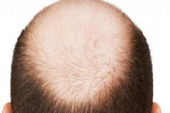 為什么男性比女性更容易脫發(fā)？男性脫發(fā)的原因有哪些？[圖]