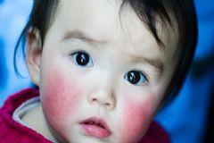 女性臉上有紅血絲是怎么回事？臉上有紅血絲怎么調(diào)理？[圖]