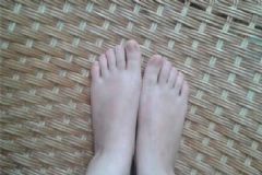 腳指甲長到肉里面該怎么辦？腳指甲長肉里處理方法有哪些？[圖]