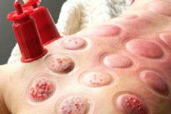 拔火罐能夠減肥嗎？拔火罐注意事項(xiàng)有哪些？[圖]