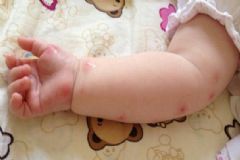 被蚊子咬了怎么消腫止癢？寶寶被蚊子咬了怎么消腫止癢？[圖]