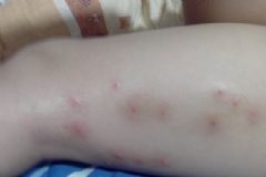 腳上起了好多小疙瘩特別癢？腳上有紅點(diǎn)是怎么回事？[圖]