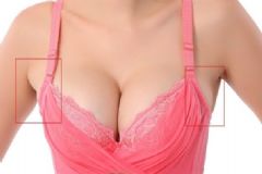 副乳怎么消除？副乳要怎么去掉？[圖]