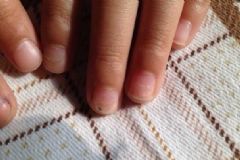 小孩指甲上有豎紋是怎么回事？小孩指甲有豎紋是缺少什么？[圖]