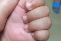 小孩指甲上有白點是怎么回事？小孩指甲有白點是什么原因？[圖]