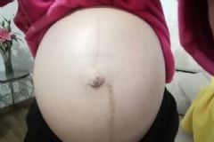 妊娠線什么時候長？妊娠線幾個月才明顯？[圖]