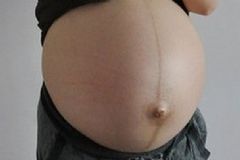 妊娠線什么時(shí)候消失？妊娠線會(huì)自己消失嗎？[圖]