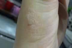 魚鱗痣怎么去除？魚鱗痣怎么治療？[圖]