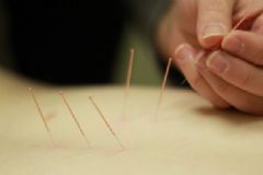 針灸減肥誤區(qū)有哪些？針灸減肥有什么要注意的？[圖]