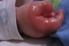 兒童燙傷后怎么護(hù)理？?jī)和癄C傷應(yīng)急處理[多圖]