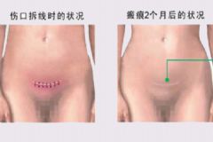 剖腹產(chǎn)傷口癢怎么辦？剖腹產(chǎn)傷口癢怎么止癢？[圖]
