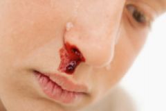 15歲男孩經(jīng)常流鼻血怎么回事？15歲男孩經(jīng)常流鼻血怎么辦？[多圖]