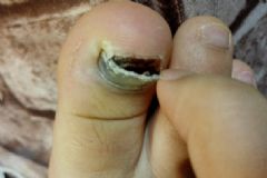 腳趾甲砸傷了有淤血腫脹怎么辦？腳趾甲被砸到紫黑色怎么辦？[圖]