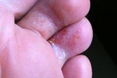 腳趾長(zhǎng)水泡很癢怎么辦？腳趾縫長(zhǎng)水泡奇癢？[圖]
