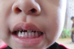 小孩乳牙蛀牙怎么辦？?jī)和檠例x齒怎么辦？[圖]