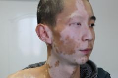 青少年患上白癜風(fēng)怎么辦？青少年患上白癜風(fēng)的原因？[多圖]