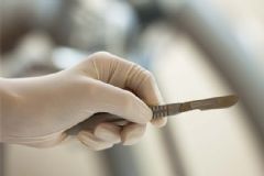 肛門息肉需要切除嗎？肛門息肉一定要手術(shù)嗎？[圖]