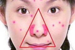 三角區(qū)的痘痘為什么不能擠？三角區(qū)長痘痘不能擠原因？[圖]
