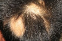 脫發(fā)有什么偏方治療？治療脫發(fā)的偏方？[圖]