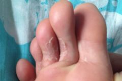 腳趾頭縫里很癢脫皮怎么回事？腳趾頭中間癢裂開怎么辦？[圖]