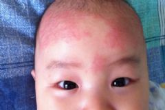 寶寶濕疹傳染嗎？寶寶濕疹怎么辦？[圖]