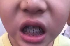 小孩牙齒發(fā)黑是什么原因？小孩牙齒黑是怎么回事？[圖]
