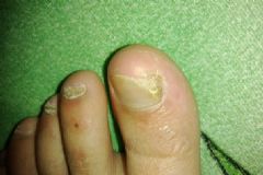 腳趾甲變厚發(fā)黃怎么回事？腳趾甲變厚是什么原因？[圖]