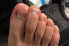 腳趾甲里面有白色粉末是怎么回事？腳趾甲里有白色粉末怎么辦？[圖]