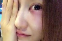熬夜眼睛腫了怎么辦才能消腫？經(jīng)常熬夜眼睛腫怎么辦？[圖]