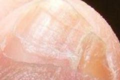 小腳趾甲兩瓣是什么原因？小腳趾甲兩瓣的傳說[圖]