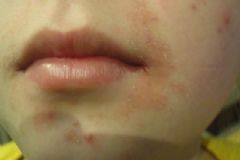 臉被燙傷怎么處理？臉被燙傷后發(fā)紅怎么辦？[多圖]