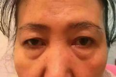 熬夜眼袋怎么消除簡單方法？熬夜眼袋重怎么消除？[圖]