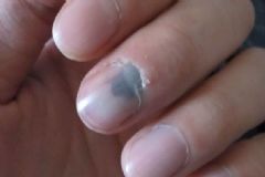 手指甲被門夾了有淤血怎么辦？門夾到手指甲內(nèi)有淤血怎么辦？[圖]
