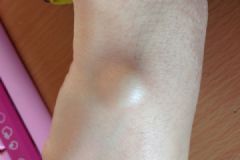我手腕上長個包怎么回事？我手腕上長了個疙瘩[多圖]