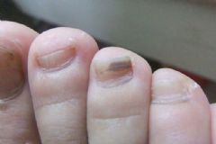 打球腳趾甲淤血怎么辦？打球腳指甲黑了怎么辦？[圖]