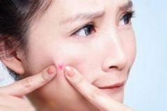 高中生臉上長痘怎么辦？高中生如何快速祛痘？[多圖]
