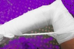 骨折需要做手術(shù)嗎？骨折一定要做手術(shù)嗎？[圖]